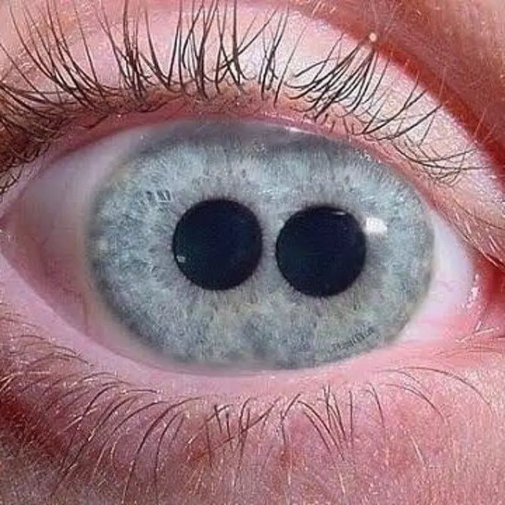 一個眼睛兩個瞳孔！20張證明「你根本就不了解人類」的罕見人類照